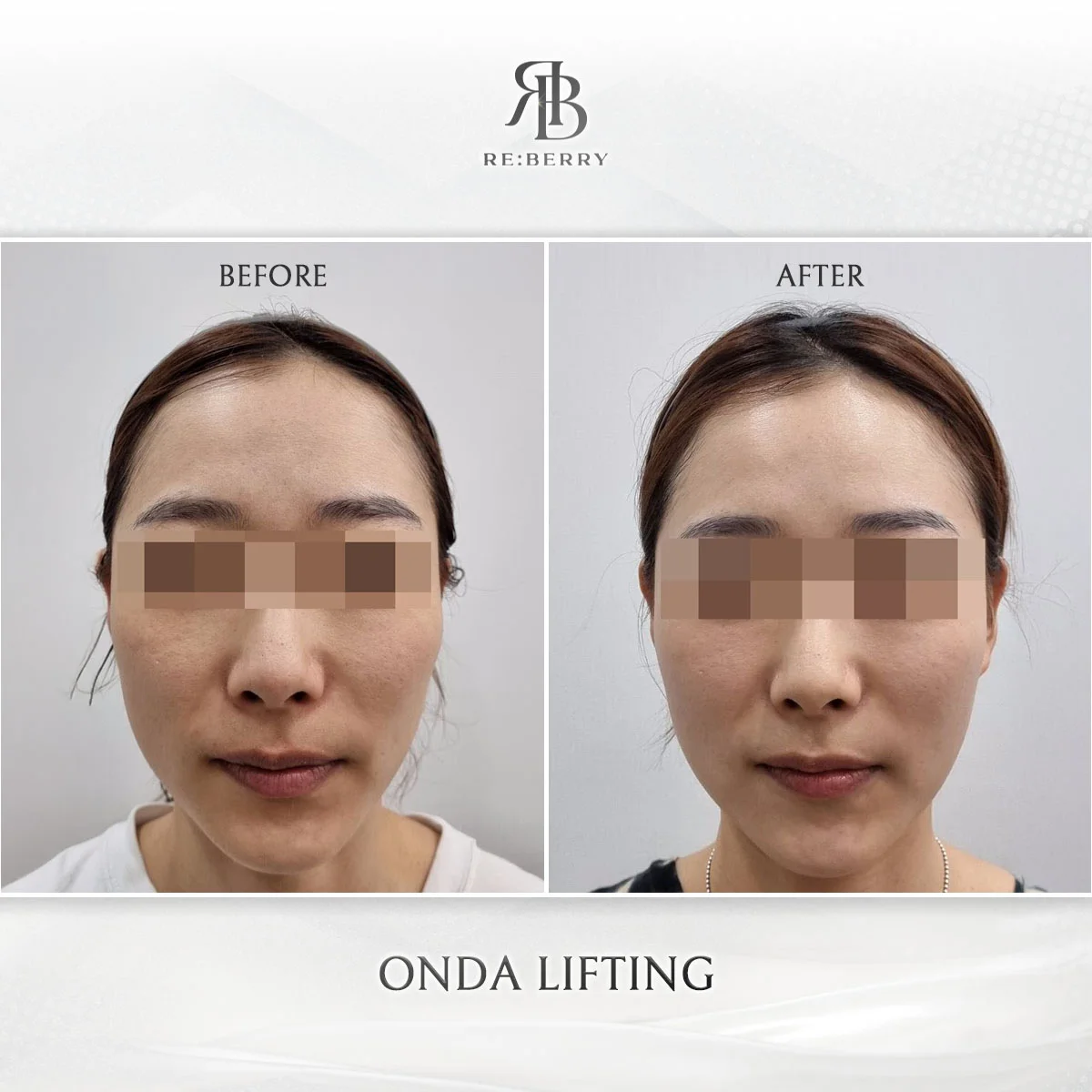 Sofwave lifting before and after case 1 at RE:BERRY Myeongdong